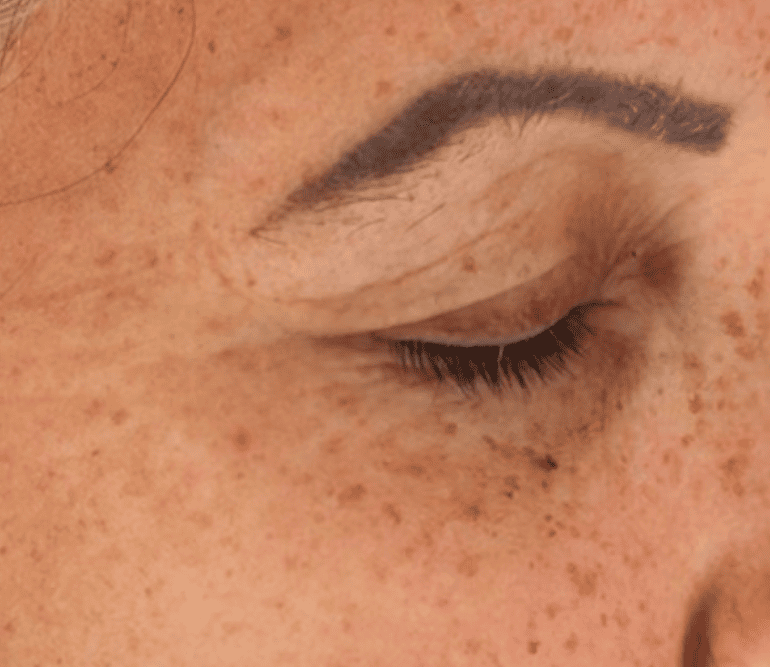 Avant / Après : La Magie Retinight