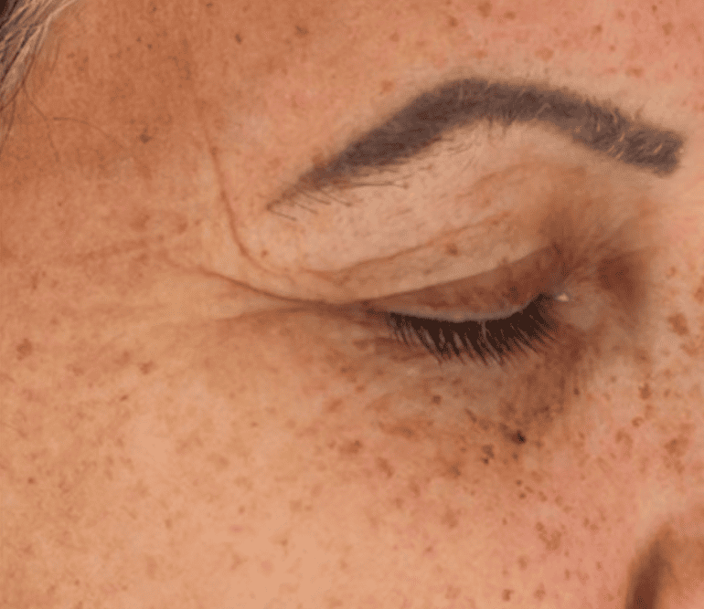 Avant / Après : La Magie Retinight